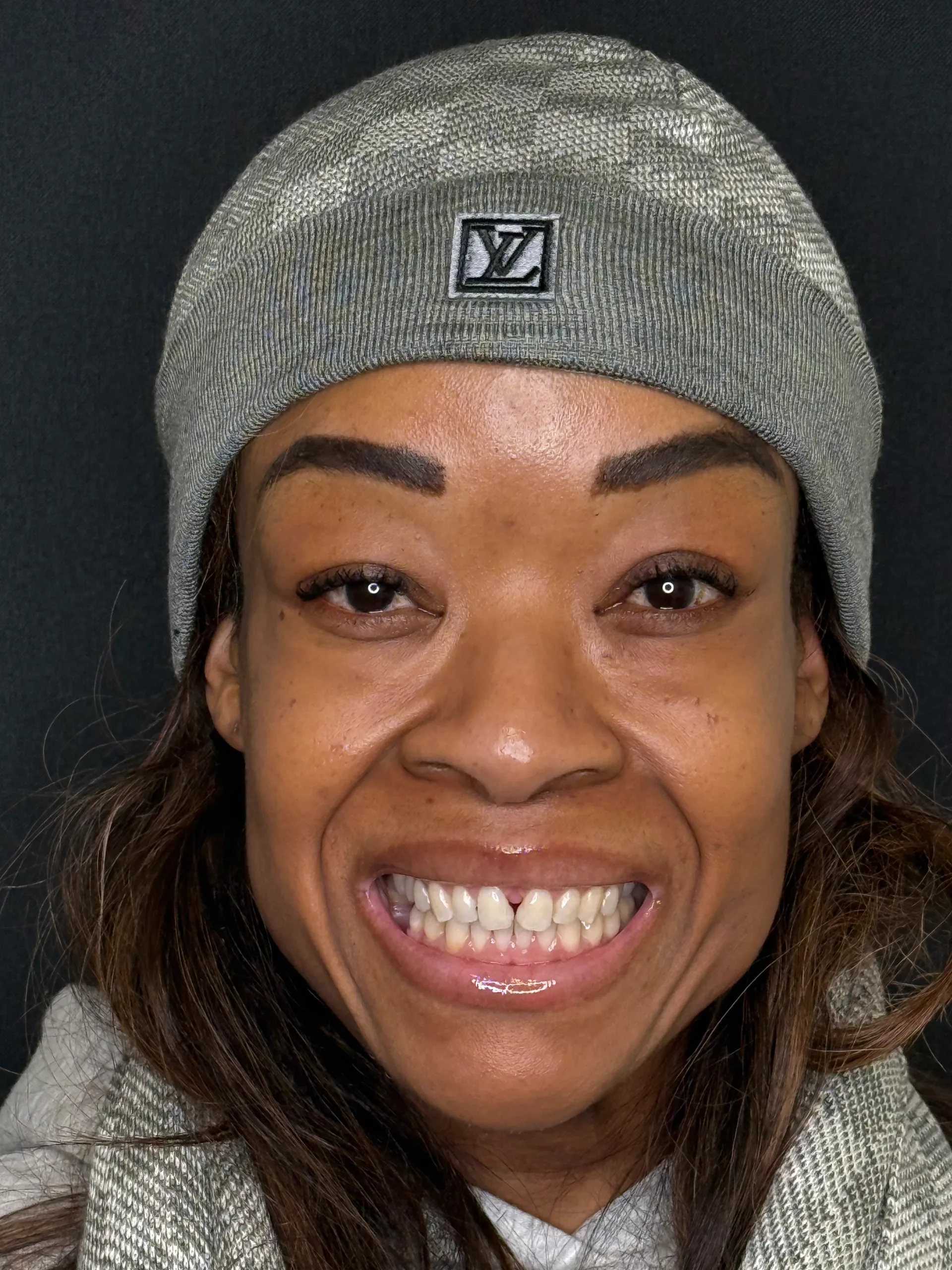 Smile Makeover · Alisha, before