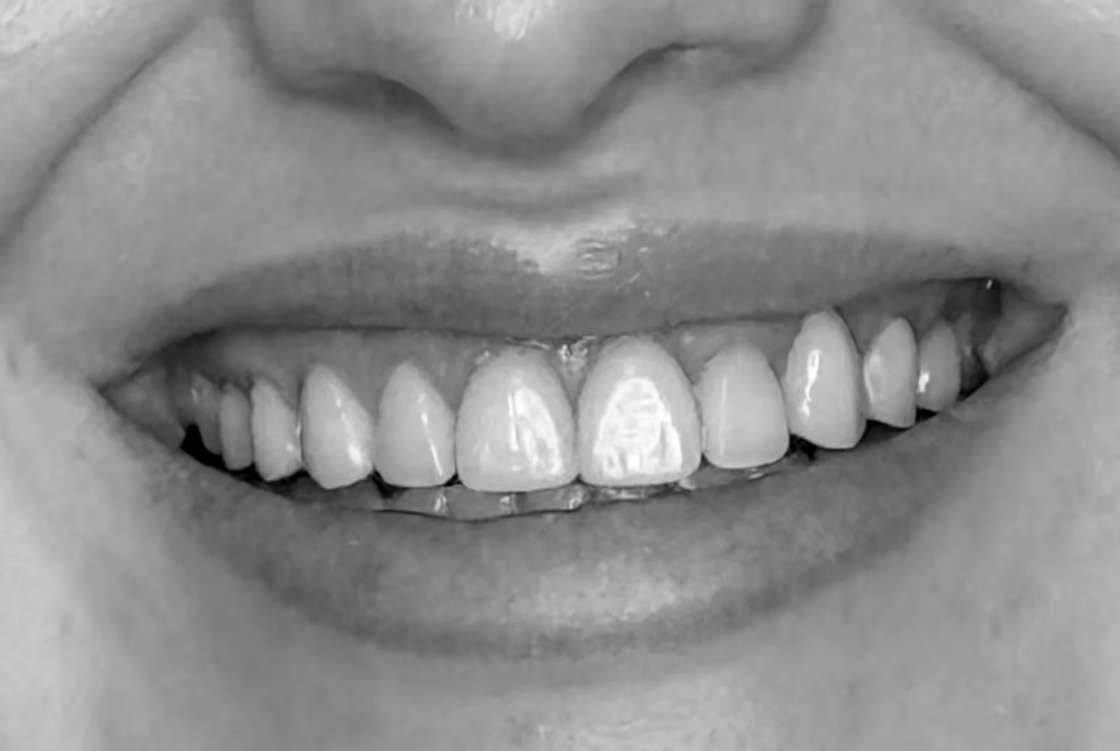 Invisalign, Veneers & Implant · Libby, after