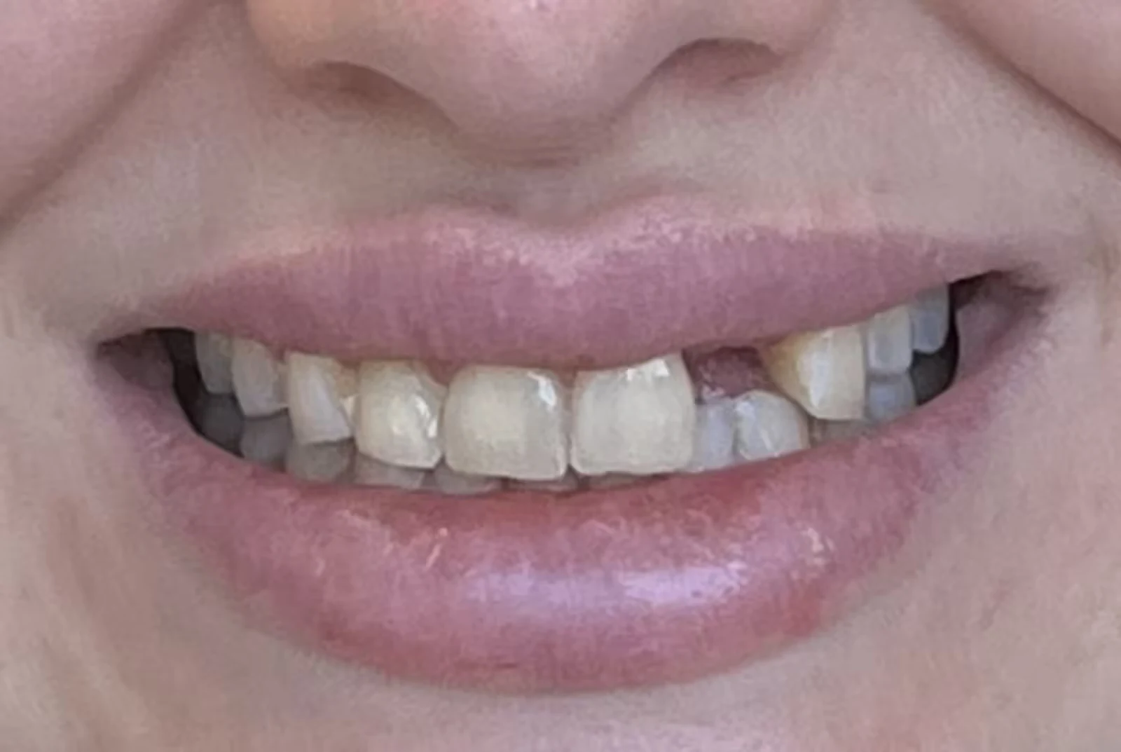 Invisalign, Veneers & Implant · Libby, before