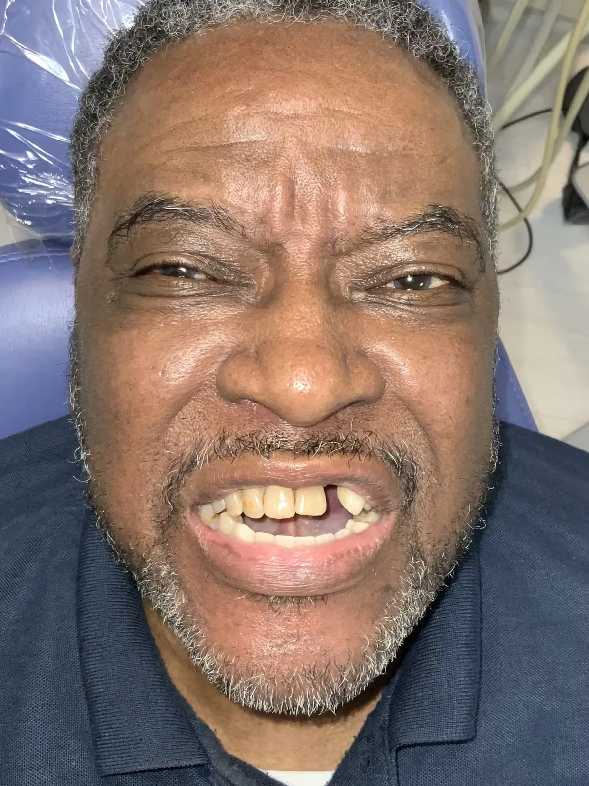 Full Mouth Reconstruction · Ron, before